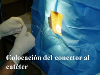 Colocación del conector al
catéter
 