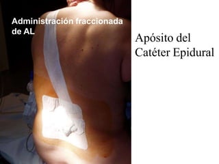 Apósito del
Catéter Epidural
Administración fraccionada
de AL
 