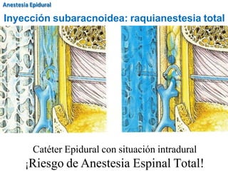 Catéter Epidural con situación intradural
¡Riesgo de Anestesia Espinal Total!
Inyección subaracnoidea: raquianestesia total
Anestesia Epidural
 