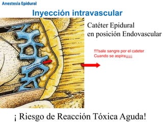 Catéter Epidural
en posición Endovascular
¡ Riesgo de Reacción Tóxica Aguda!
!!!!sale sangre por el cateter
Cuando se aspira¡¡¡¡¡
Inyección intravascular
Anestesia Epidural
 