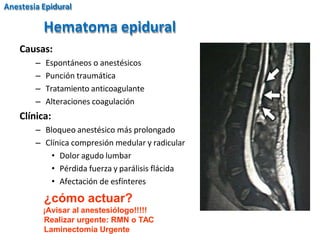 Hematoma epidural
Causas:
– Espontáneos o anestésicos
– Punción traumática
– Tratamiento anticoagulante
– Alteraciones coagulación
Clínica:
– Bloqueo anestésico más prolongado
– Clínica compresión medular y radicular
• Dolor agudo lumbar
• Pérdida fuerza y parálisis flácida
• Afectación de esfínteres
¿cómo actuar?
¡Avisar al anestesiólogo!!!!!
Realizar urgente: RMN o TAC
Laminectomía Urgente
Anestesia Epidural
 