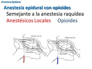 Anestesia Epidural
Anestesia epidural con opioides
Semejante a la anestesia raquídea
Anestésicos Locales Opioides
 
