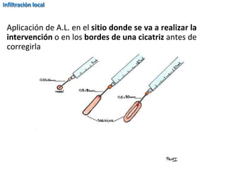 Infiltración local
Aplicación de A.L. en el sitio donde se va a realizar la
intervención o en los bordes de una cicatriz antes de
corregirla
 