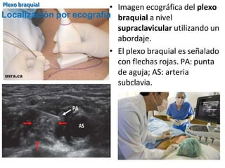 • Imagen ecográfica del plexo
braquial a nivel
supraclavicular utilizando un
abordaje.
• El plexo braquial es señalado
con flechas rojas. PA: punta
de aguja; AS: arteria
subclavia.
Localización por ecografía
Plexo braquial
 