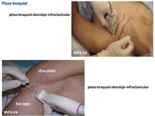 plexo braquial abordaje infraclavicular
plexo braquial abordaje infraclavicular
Plexo braquial
 
