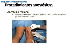 • Anestesia regional
 Bloqueos nerviosos ciático poplíteo externo en fosa poplítea,
guiado por estimulador
Procedimientos anestésicos
Bloqueos nerviosos troculares
 