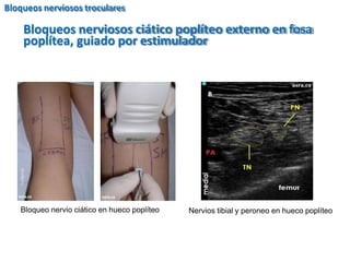 Bloqueos nerviosos ciático poplíteo externo en fosa
poplítea, guiado por estimulador
Bloqueo nervio ciático en hueco poplíteo
Ciático en hueco poplíteo
Nervios tibial y peroneo en hueco poplíteo
Bloqueos nerviosos troculares
 