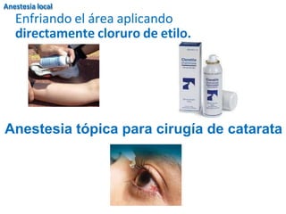 Enfriando el área aplicando
directamente cloruro de etilo.
Anestesia tópica para cirugía de catarata
Anestesia local
 
