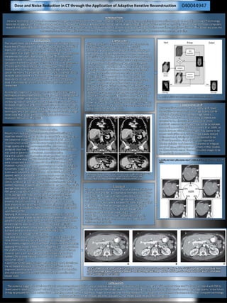 INTRODUCTION
Iterative reconstruction was used to reconstruct images in Hounsfield’s first CT scanner. However, the ever increasing computational power required to apply IR to rapidly evolving CT technology,
restricted its application, and filtered back projection (FBP) was accepted as a means of reconstructing the images instead (Beister, Kolditz and Kalender, 2012). With the advent of faster computers,
research into applying Adaptive Iterative Reconstruction (IR) as a means to reduce patient dose has proved favourable with regards to image quality comparisons with FBP. This poster discusses the
advances of IR and how its applications have led to a measurable reduction in patient dose, while not compromising on image quality.
1. DISCUSSION
The results of the 2003 National Radiation Protection Board survey
found that CT examinations in the UK make up only 9% of medical
exposures, yet contribute to 47% of the total radiation dose
(Shrimpton et al, 2005), demonstrating a doubling in CT doses from
the previous ten years (Hart and Wall, 2004). This exponential
increase in dose is supported by Karpitschka et al, (2013) who
calculated that there has been a 12-fold increase in the amount of
CT scans performed in the UK in the last 25 years. The cancer
inducing effects of radiation are well known with the lifetime
cancer risk from CT scans being estimated at 2% (Silva et al, 2010).
With the advancement in CT technology and the growing
dependence on high dose procedures, it is apparent that patient
dose is of increasing concern, and reduction methods must be
researched.
According to Sagara et al, (2010), currently available dose-saving
techniques already implemented into CT has been hindered by the
limitations of FBP. Whilst lowering the tube current (mA) and
increasing rotation speed decreases patient dose; it also results in
increased image noise and inconsistencies in FBP reconstructions.
Modern computer technology allows for the implementation of IR
techniques which are capable of identifying and subtracting image
noise (Silva et al, 2010) without reducing spatial or contrast
resolution (Mitsumori et al, 2012).
Dose and Noise Reduction in CT through the Application of Adaptive Iterative Reconstruction
3. Appearances of IR
It is generally agreed upon that by applying IR, lower
doses without a compromise on image quality can be
achieved. Nevertheless; inherent image noise is
something that has been traditionally accepted and
expected in CT. The noise free appearance of the
iteratively reconstructed images may not be acceptable
or appealing to radiologists initially (Hara et al, 2009), as
reports have concluded these images may appear to be
over-smooth (Silva et al, 2010) or have a waxy texture
(Mitsumori et al, 2012); and could be deemed to be
artifacts themselves. Singh et al, (2010) reported a
blotchy pixilation and decreased sharpness or irregular
margin of cysts, solid organs and vessels in their studies;
yet these did not render the reconstructed images to be
diagnostically unacceptable.
2. What is IR?
Different vendors use different methods of IR processes,
but all follow the same basic principle. The initial
information from the FBP is used as a ‘building block’ and
the value of each pixel is transformed to a new estimated
value (Silva et al, 2010). These pixels are forward projected
to produce estimated projections which are then compared
to the measured values (Karpitschka et al, 2013). After a
correction factor is obtained, this is back-projected across
the original estimated values to produce new estimated
vales. The process is repeated, correcting the data by
reducing the difference between the two projections
(Hsieh, 2009), until the estimates match these measured
values , or a fixed number of iterations are reached
(Beister, Kolditz and Kalender, 2012). (Fig. 1) This software
is known as Adaptive Statistical Iterative Reconstruction
(ASIR) on GE scanners, and Image Reconstruction in Image
Space (IRIS) on Siemens. GE has followed on with a more
complex model based iterative reconstruction method,
known as ‘VEO’ (Beister, Kolditz and Kalender, 2012), which
claims to allow for ‘ultra low dose’ scanning with increased
spatial resolution (Thibault 2011).
4. Blending
IR can be applied to a low dose CT scan as a linear mixture or
a ‘blend’ of IR and FBP; a compromise intended to produce a
more typical CT image with significantly reduced dose (Hara
et al, 2009). These reports of unfamiliar over-smoothening
are based on studies where between 70-100% IR was applied
to low dose FBP. The percentage values can typically be
adjusted in 10% increments: as the percentage of IR
increases, image noise decreases (Fig.2), therefore
controlling the amount of over-smoothing (Silva, et al.,
2010), resulting in images more familiar to radiologists
(Mitsumori et al, 2012).
5. Noise and Dose Reduction
Results from multiple studies comparing both subjective and
objective research give promise for the use of IR in dose saving. In
the subjective studies, radiologists who were blinded to the
reconstruction properties of the scan were asked to score on
image quality and diagnostic acceptability. This was performed
alongside objective research, where a region of interest (ROI) tool
was used on patients or phantoms to measure noise.
Hara et al, (2009) measured noise as being reduced by 75% with
100% IR on low dose CT, with dose halved with 50% IR. Images
were comparable with full dose FBP when 30% IR was applied.
However it produced an average reduction of 44% in dose (Fig 3.).
Conversely, Singh et al, (2010) reported that low dose 100% FBP
scans were suboptimal, whilst those that had 30% and 50% IR
applied, were acceptable with no compromise on vessel or lesion
conspicuity. Both Mitsumori et al, (2012) and Karpitschka et al,
(2013), achieved an average of 40% dose reduction using 50% IR;
neither reporting an appreciable reduction in image quality. A 28%
average dose reduction with comparable image quality to full dose
FBP while using 40% IR was reported by Sagara et al, (2010) and
31.5% average dose reduction by Desai et al, (2012) with the
application of 30% IR, giving a 33.3% reduction in noise. This
presents the conclusion that as the percentage of IR increases,
dose and noise decreases, without compromise on image quality
or diagnostic acceptability (fig 4) when used with the best agreed
upon blend of FBP.
Applying IR techniques has been shown to lower the increased
noise and photon starvation artefact created when imaging obese
patients (Silva et al, 2010). Desai et al, (2012) supports this when
researching the application of IR on patients weighing ≥91 kg
where IR gave at least comparable diagnostic acceptability to FBP,
but with noise and dose reductions of 50% and 21.4%,
respectively, on average for this group.
Low dose procedures currently in clinical use, such as those for
renal stones, coronary calcium plaques and colonography, allow
for increased image noise outside of the area of interest. However,
applying IR has shown a reduction in image noise can demonstrate
the anatomy of the solid organs traditionally obscured by image
noise on such scans, while also potentially lowering dose by a
further 25%, or even halving it in the case of CT colonography
(Silva et al, 2010).
A potential further application suggested by Hara et al, (2009) was
the increased resolution of typically noisy thin slices and their
diagnostic potential when reconstructed with IR for the detection
and characterisation of lesions which may have been missed on
thicker slices.
6. CONCLUSION
The evidence suggests that with an advancement in computer capabilities and an adaptive approach to iterative reconstruction, IR is a feasible method when used in the correct blend with FBP to
lower patient radiation dose and reduce the noise that would be incident on the resultant FBP image, without compromising on, and even in some instances improving, on image quality. In the future
it may be possible to further reduce dose with higher percentages of IR applied to images as they become more acceptable to radiologists, and as further advancements in faster computer technology
and more advanced IR techniques becomes available such as Model Based Iterative Reconstruction.
Fig 1. Schematic of the IR process (Beister, Kolditz and Kalender, 2012).
Fig 3. Example of low dose images which were reconstructed with FBP (A&C) showing
noisy images compared against the same images reconstructed with IR (B&D)
demonstrating a smoother appearance (Beister, Kolditz and Kalender, 2012.
Fig 2. Diagram showing the appearances of applying IR in increasing increments (Silva et al,
2010) .
040044947
Fig 4. 3 images of the same slice with different doses and reconstruction methods applied. A is a 100% FBP image demonstrating more
noise than image B which has had IR applied, and has comparable image quality and diagnostic acceptability to C which is a full dose
scan with FBP (Hara et al, 2009)
 