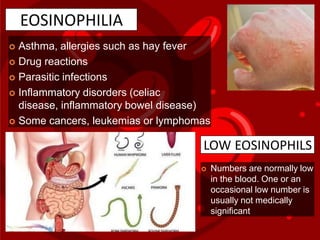 EOSINOPHILIA
 Asthma, allergies such as hay fever
 Drug reactions
 Parasitic infections
 Inflammatory disorders (celiac
disease, inflammatory bowel disease)
 Some cancers, leukemias or lymphomas
LOW EOSINOPHILS
 Numbers are normally low
in the blood. One or an
occasional low number is
usually not medically
significant
 