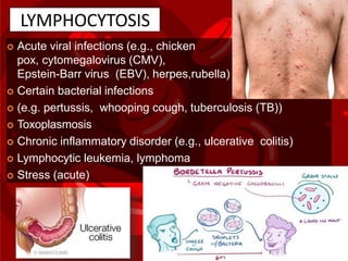 LYMPHOCYTOSIS
 Acute viral infections (e.g., chicken
pox, cytomegalovirus (CMV),
Epstein-Barr virus (EBV), herpes,rubella)
 Certain bacterial infections
 (e.g. pertussis, whooping cough, tuberculosis (TB))
 Toxoplasmosis
 Chronic inflammatory disorder (e.g., ulcerative colitis)
 Lymphocytic leukemia, lymphoma
 Stress (acute)
 
