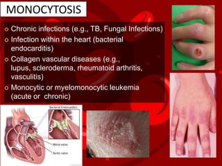 MONOCYTOSIS
 Chronic infections (e.g., TB, Fungal Infections)
 Infection within the heart (bacterial
endocarditis)
 Collagen vascular diseases (e.g.,
lupus, scleroderma, rheumatoid arthritis,
vasculitis)
 Monocytic or myelomonocytic leukemia
(acute or chronic)
 