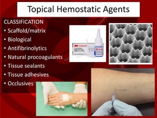Topical Hemostatic Agents
CLASSIFICATION
• Scaffold/matrix
• Biological
• Antifibrinolytics
• Natural procoagulants
• Tissue sealants
• Tissue adhesives
• Occlusives
 