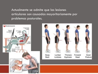 Actualmente se admite que las lesiones
articulares son causadas mayoritariamente por
problemas posturales.
 