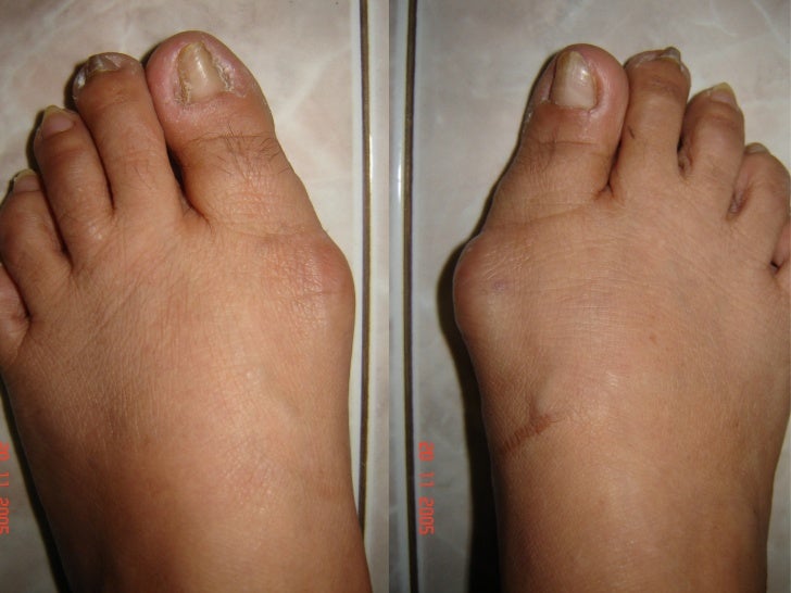 1foot Hallux Valgus