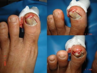 1foot nail inj suture