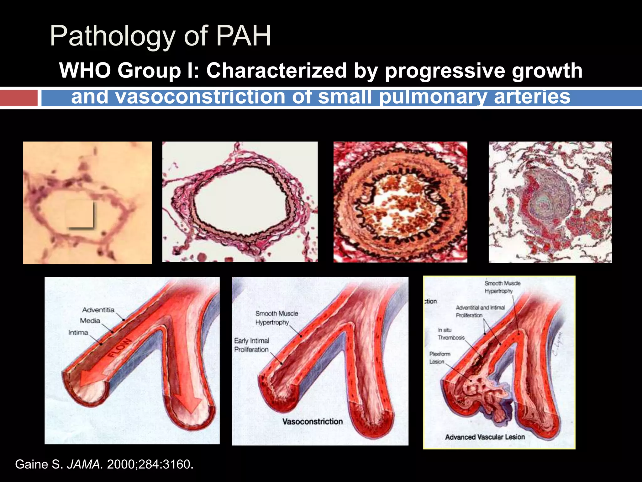 Pulmonary Hypertension Basics 2021 | PPTX