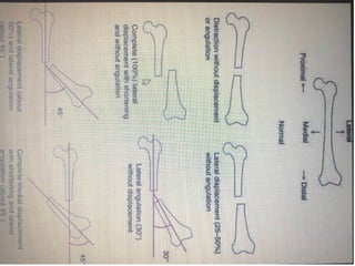 Comprehensive Overview of Bone Fractures: Types, Causes, Diagnosis, and ...