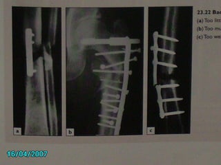 Comprehensive Overview of Bone Fractures: Types, Causes, Diagnosis, and ...