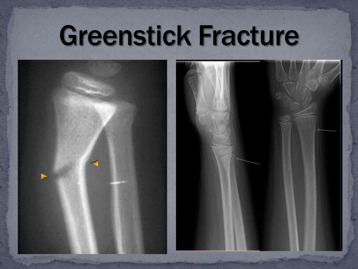 3 bone fractures greenstick fracture