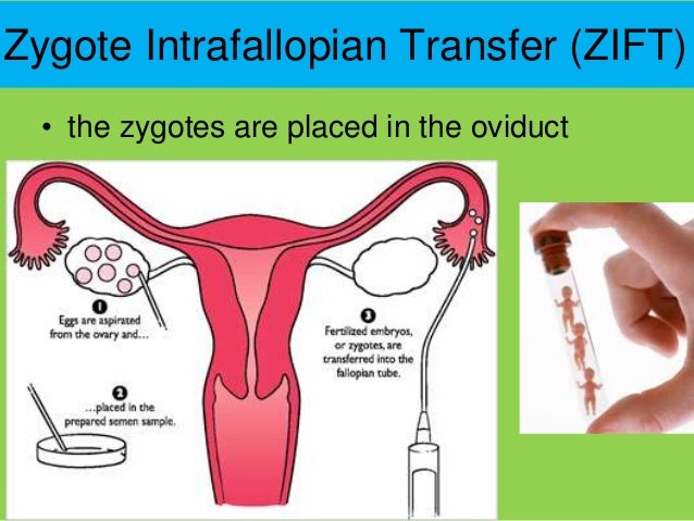 Zift How Insert Zygote Intrafallopian Transfer Zift