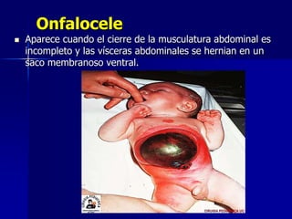 Onfalocele
 Aparece cuando el cierre de la musculatura abdominal es
incompleto y las vísceras abdominales se hernian en un
saco membranoso ventral.
 
