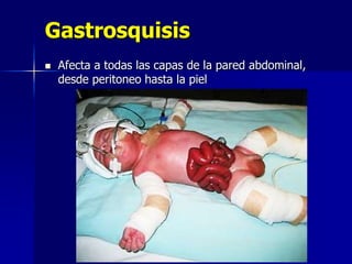 Gastrosquisis
 Afecta a todas las capas de la pared abdominal,
desde peritoneo hasta la piel
 