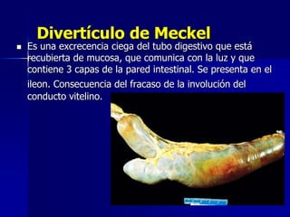 Divertículo de Meckel
 Es una excrecencia ciega del tubo digestivo que está
recubierta de mucosa, que comunica con la luz y que
contiene 3 capas de la pared intestinal. Se presenta en el
ileon. Consecuencia del fracaso de la involución del
conducto vitelino.
 