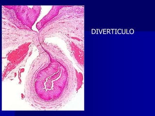 DIVERTICULO
 