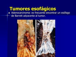 Tumores esofágicos
 Adenocarcinoma: es frecuente encontrar un esófago
de Barrett adyacente al tumor.
 