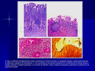 A. Hay un infiltrado linfoplasmocítico denso superficial en la lámina propia. B. Agregado linfoide; cuando está presente,
es altamente sugestivo de Helicobacter. C. Los neutrófilos se encuentran dispersos en el infiltrado de la lámina propia y
pueden penetrar el epitelio glandular. D. La tinción de Warthin- Starry resalta los pequeños organismos curvilíneos en la
superficie foveolar
 
