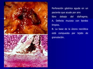 Perforación gástrica aguda en un
paciente que acude por aire
libre debajo del diafragma.
A. Defecto mucoso con bordes
limpios.
B. La base de la úlcera necrótica
está compuesta por tejido de
granulación.
 