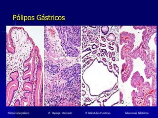 Pólipos Gástricos
Pólipo hiperplásico P. Hiperpl. Ulcerado P. Glándulas Fundicas Adenomas Gástricos
 