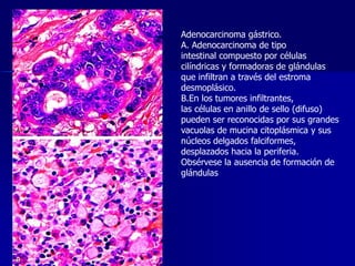 Adenocarcinoma gástrico.
A. Adenocarcinoma de tipo
intestinal compuesto por células
cilíndricas y formadoras de glándulas
que infiltran a través del estroma
desmoplásico.
B.En los tumores infiltrantes,
las células en anillo de sello (difuso)
pueden ser reconocidas por sus grandes
vacuolas de mucina citoplásmica y sus
núcleos delgados falciformes,
desplazados hacia la periferia.
Obsérvese la ausencia de formación de
glándulas
 