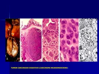 TUMOR CARCINOIDE DIGESTIVO (CARCINOMA NEUROENDOCRINO)
 