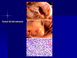 Tumor GI del estroma
 
