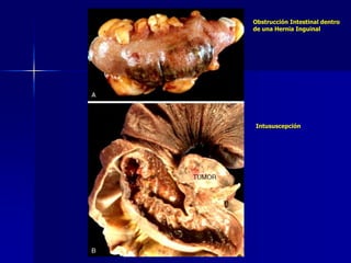 Obstrucción Intestinal dentro
de una Hernia Inguinal
Intususcepción
 