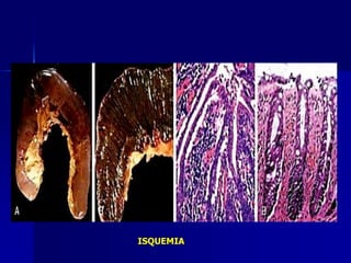 ISQUEMIA
 