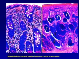 Enfermedad Celíaca. T:núcleo de linfocito T comparar con E: núcleo de célula epitelial
 