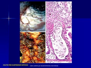 COLITIS POR CLOSTRIDIUM DIFFICILE
Colon cubierto por seudomembranas marronáceas
 
