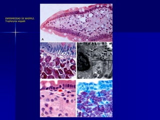 ENFERMEDDAD DE WHIPPLE.
Tropheryma wippelii
 