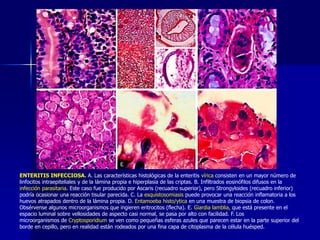 ENTERITIS INFECCIOSA. A. Las características histológicas de la enteritis vírica consisten en un mayor número de
linfocitos intraepiteliales y de la lámina propia e hiperplasia de las criptas. B. Infiltrados eosinófilos difusos en la
infección parasitaria. Este caso fue producido por Ascaris (recuadro superior), pero Strongyloides (recuadro inferior)
podría ocasionar una reacción tisular parecida. C. La esquistosomiasis puede provocar una reacción inflamatoria a los
huevos atrapados dentro de la lámina propia. D. Entamoeba histo/ytica en una muestra de biopsia de colon.
Obsérvense algunos microorganismos que ingieren eritrocitos (flecha). E. Giardia lamblia, que está presente en el
espacio luminal sobre vellosidades de aspecto casi normal, se pasa por alto con facilidad. F. Los
microorganismos de Cryptosporidium se ven como pequeñas esferas azules que parecen estar en la parte superior del
borde en cepillo, pero en realidad están rodeados por una fina capa de citoplasma de la célula huésped.
 