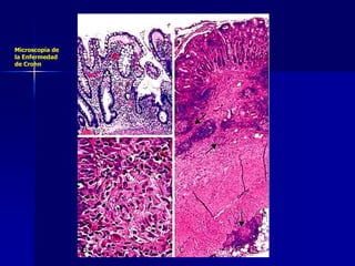 Microscopía de
la Enfermedad
de Crohn
 