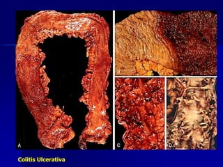 Colitis Ulcerativa
 