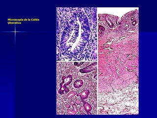 Microscopía de la Colitis
Ulcerativa
 