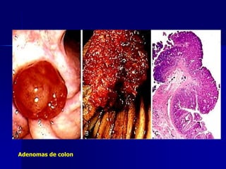 Adenomas de colon
 
