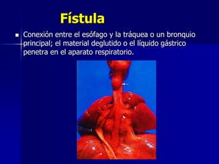 Fístula
 Conexión entre el esófago y la tráquea o un bronquio
principal; el material deglutido o el líquido gástrico
penetra en el aparato respiratorio.
 