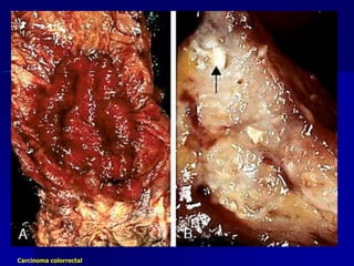 Carcinoma colorrectal
 