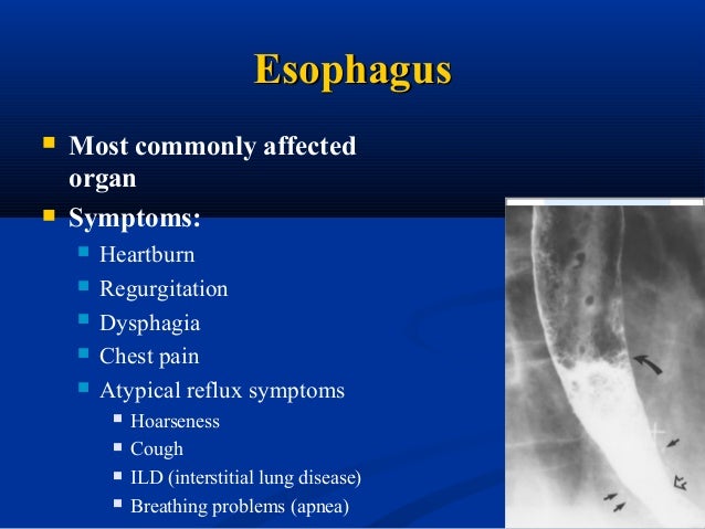 1 gastrointestinal manifestations of systemic sclerosis