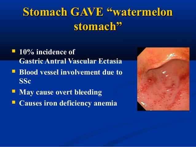 1 gastrointestinal manifestations of systemic sclerosis